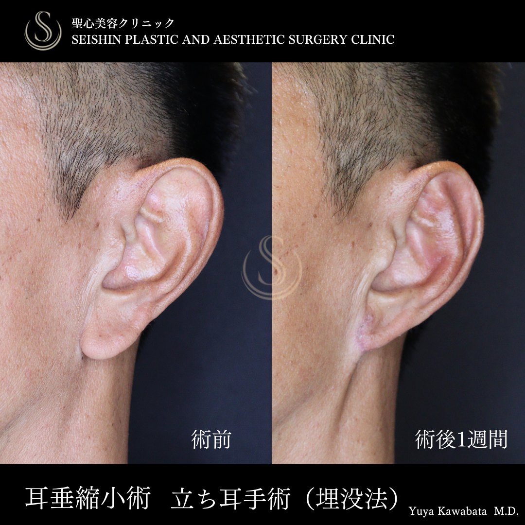 立ち耳修正（埋没法）_After