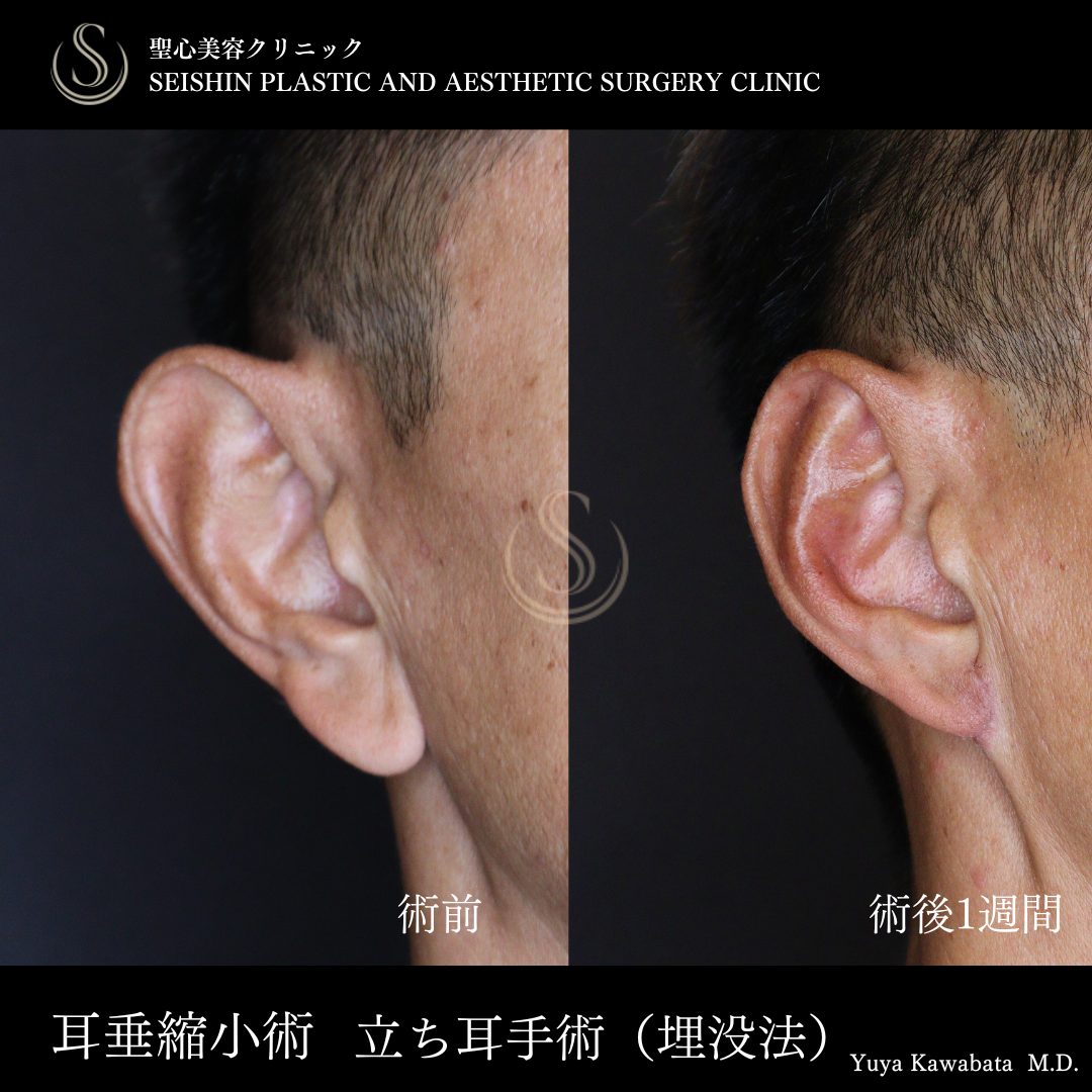立ち耳修正（埋没法）_Before