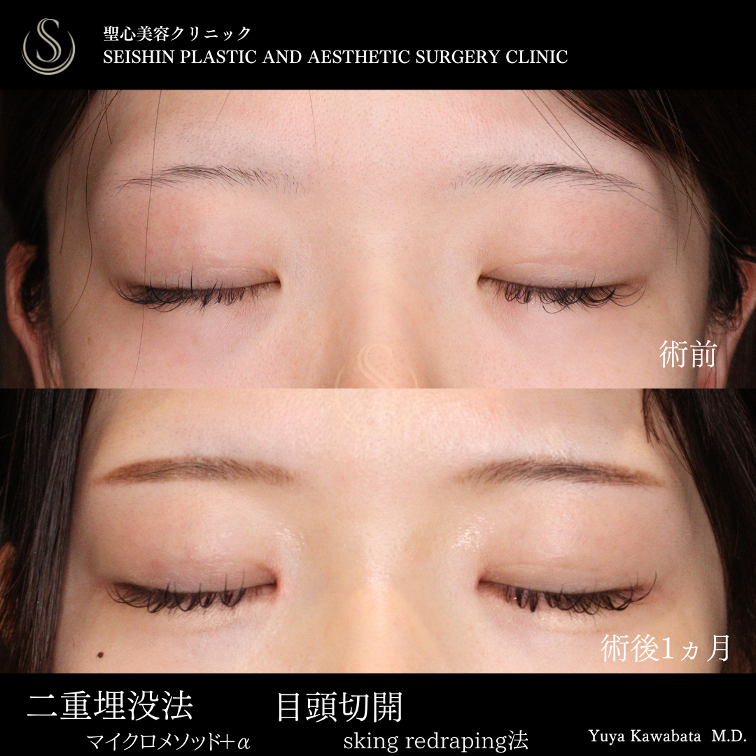 二重術（埋没法）：マイクロメソッド+α＋目頭切開/目上切開_After