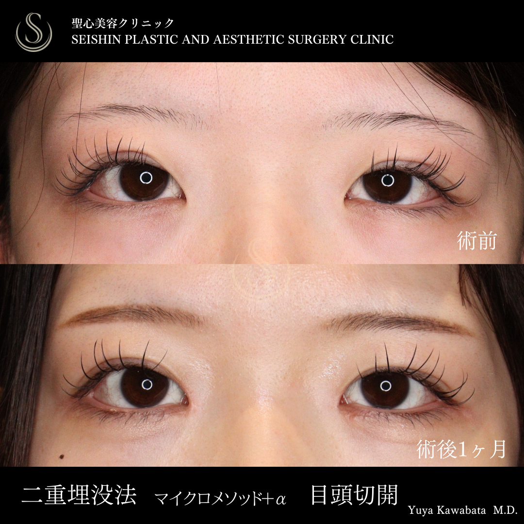 二重術（埋没法）：マイクロメソッド+α＋目頭切開/目上切開_Before