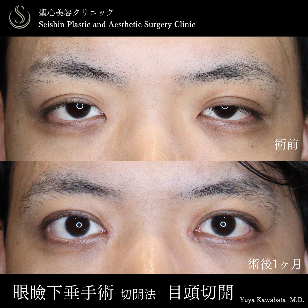 眼瞼下垂（切開法/腱膜縫縮法）＋目頭切開/目上切開_Before