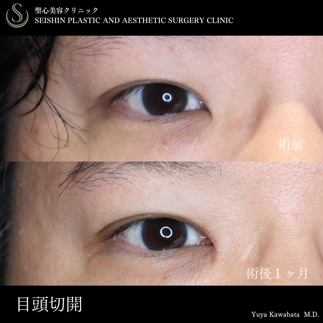 目頭切開/目上切開_After