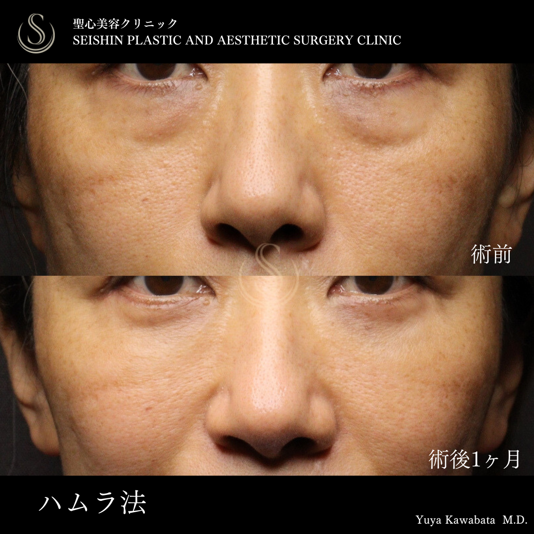 下眼瞼切開術/下眼瞼除皺術/ハムラ法_Before