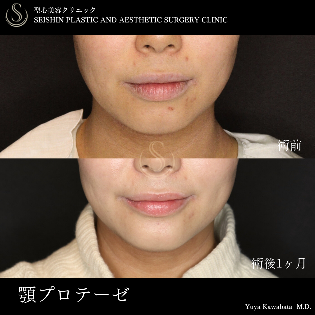 あごプロテーゼ_After