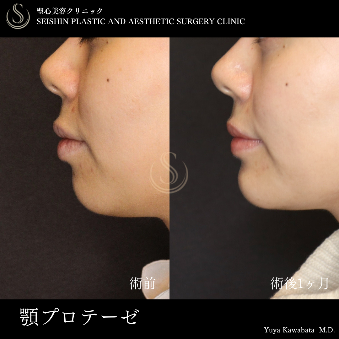 あごプロテーゼ_Before