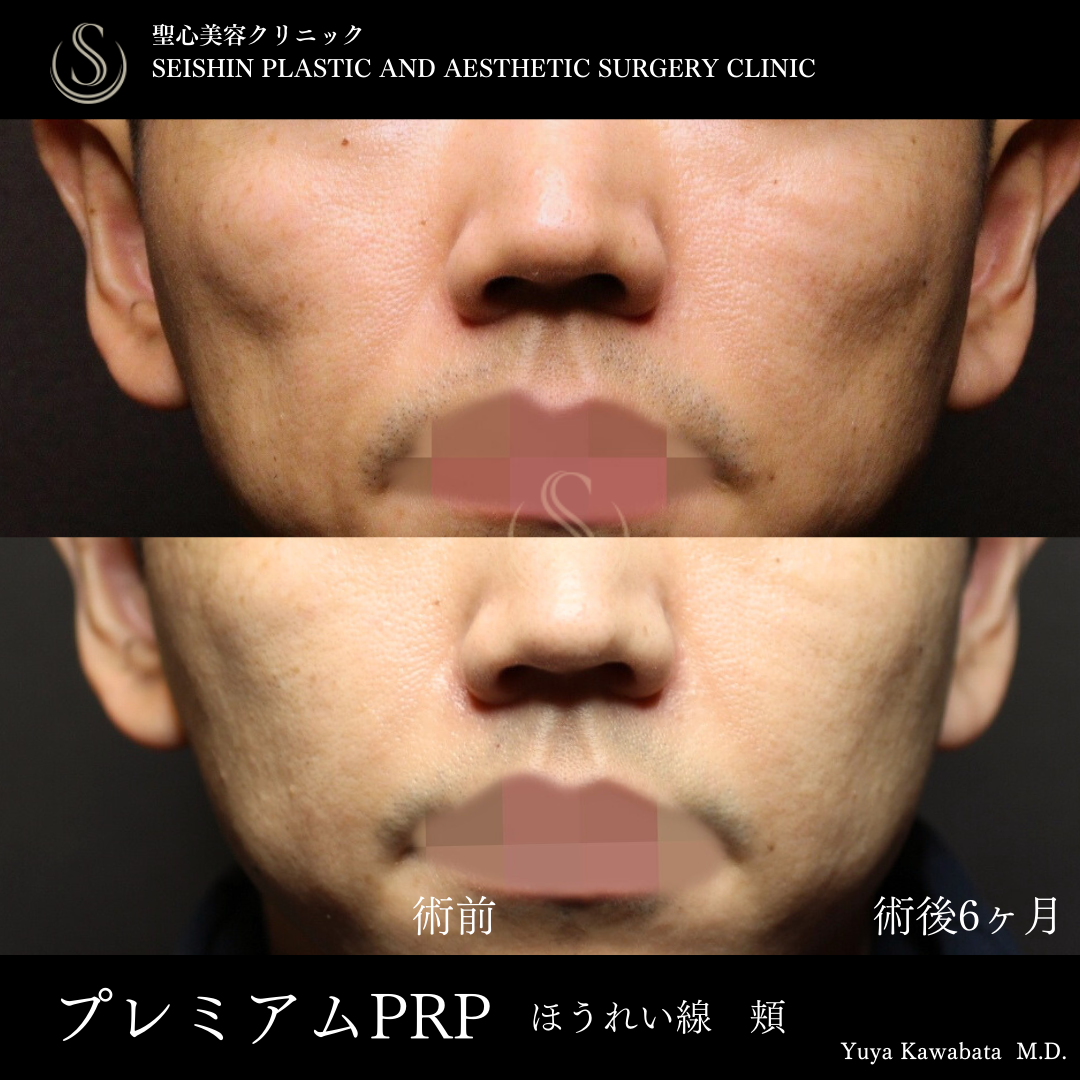 プレミアムPRP皮膚再生療法_Before