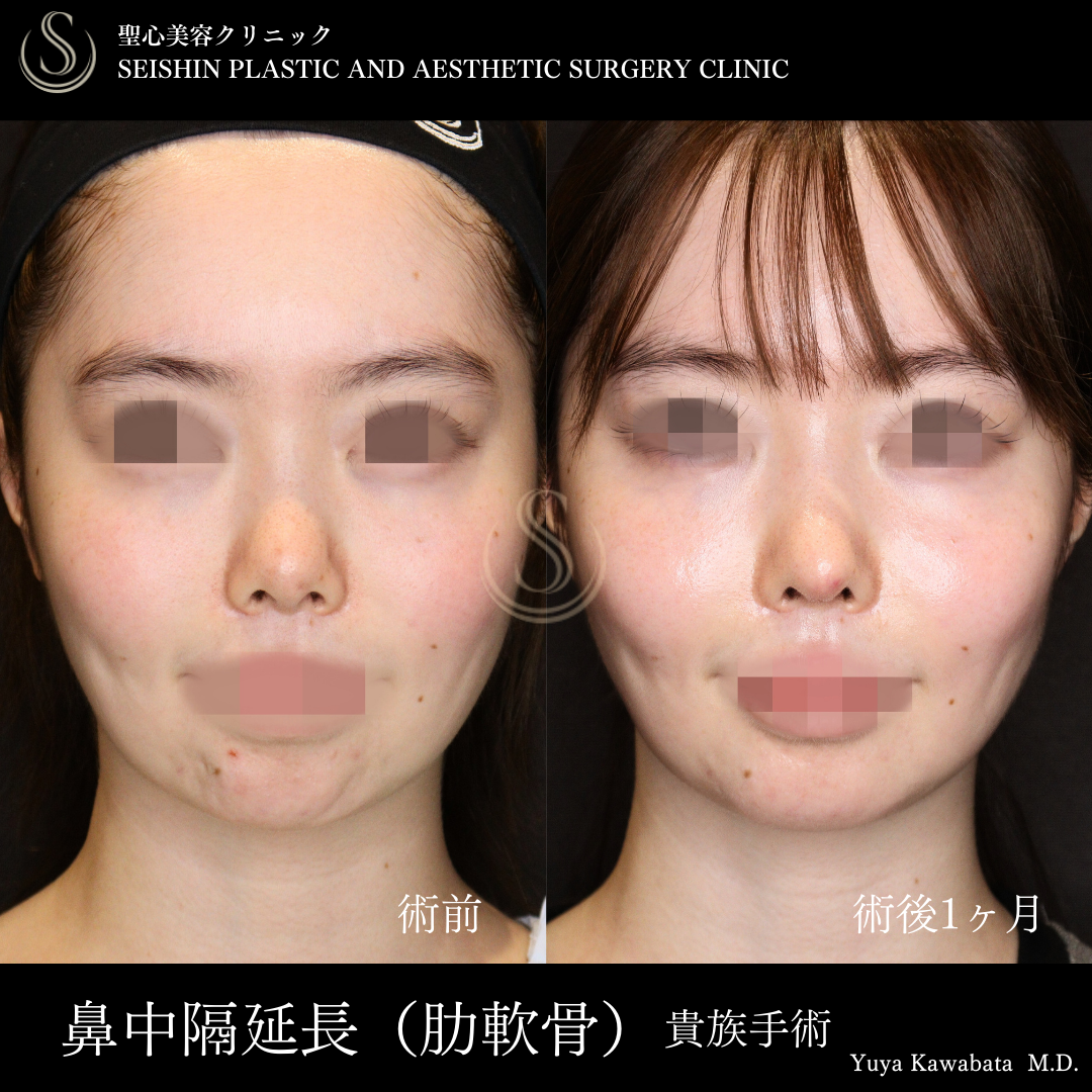 鼻中隔延長術＋鼻尖縮小＋貴族手術_After