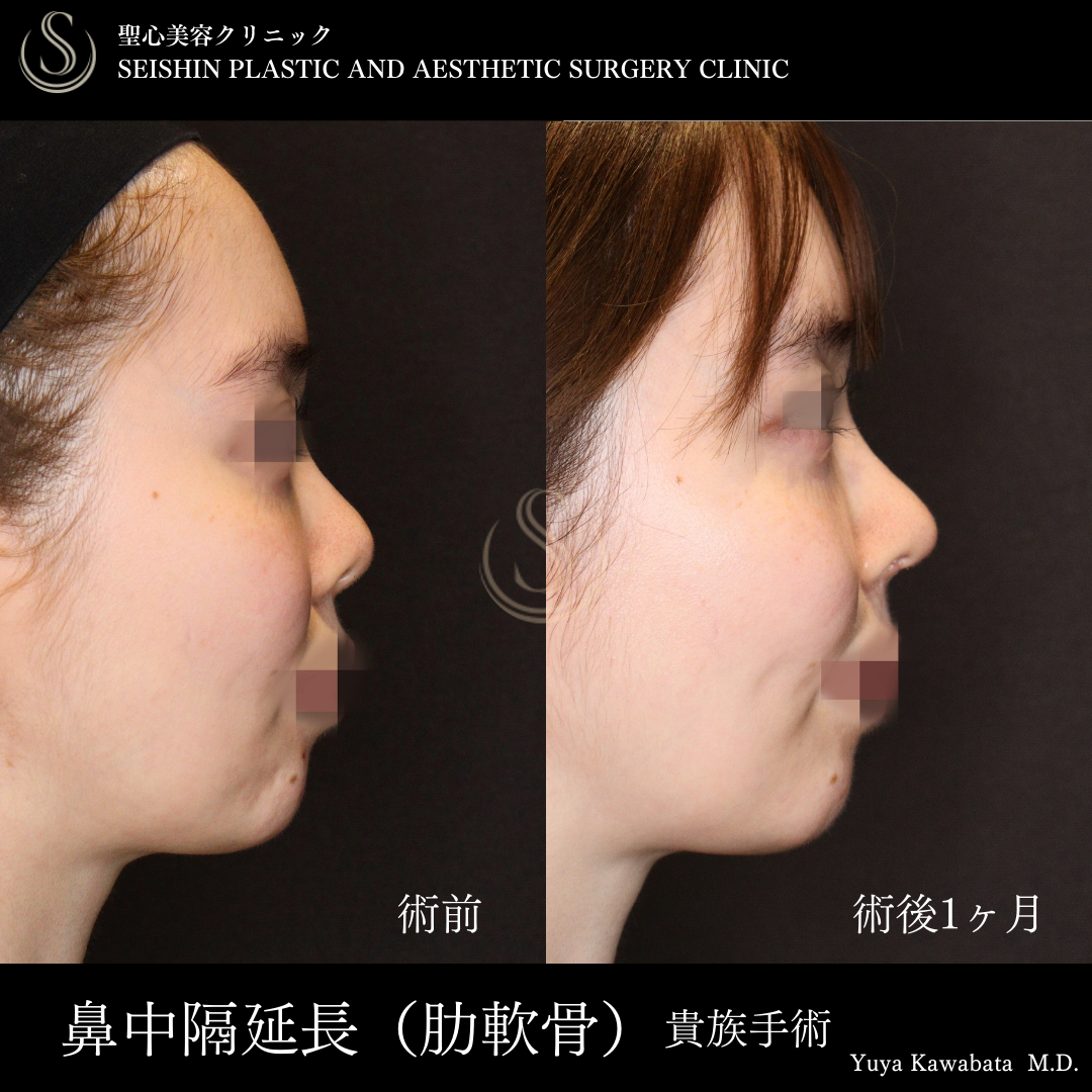 鼻中隔延長術＋鼻尖縮小＋貴族手術_Before