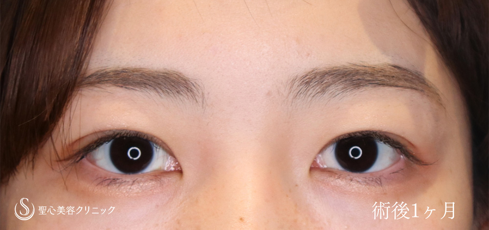 二重術（埋没法）：マイクロメソッド+α_After