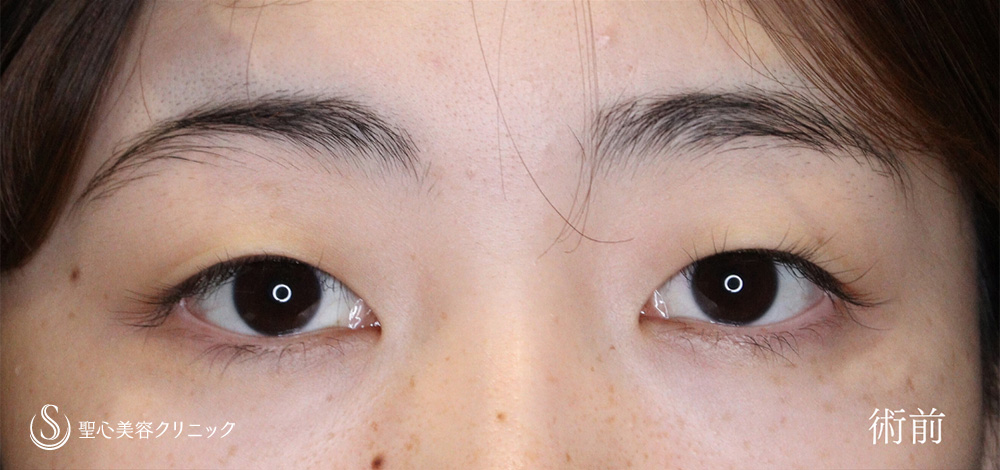 二重術（埋没法）：マイクロメソッド+α_Before