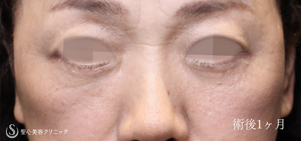 下眼瞼切開術/下眼瞼除皺術/ハムラ法_After