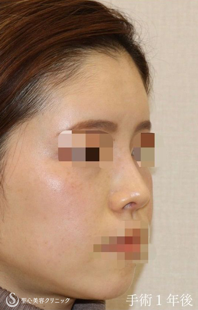 鼻中隔延長（耳介軟骨移植）＋鼻尖形成（耳介軟骨移植）＋鼻背軟骨移植（耳介軟骨移植）＋他院修正_After