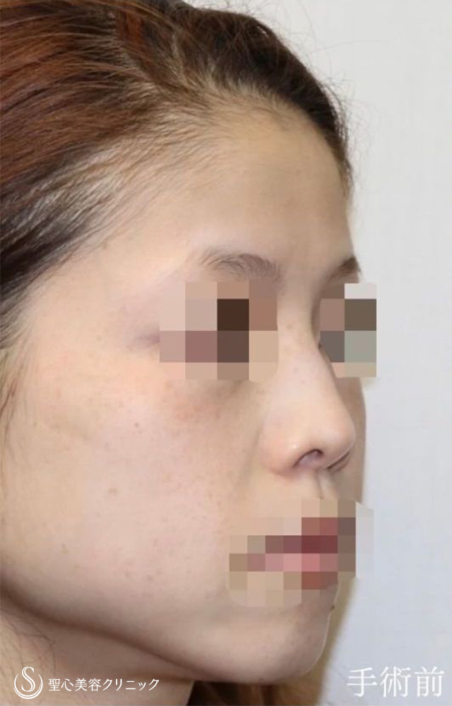 鼻中隔延長（耳介軟骨移植）＋鼻尖形成（耳介軟骨移植）＋鼻背軟骨移植（耳介軟骨移植）＋他院修正_Before