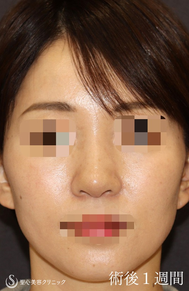 鼻尖縮小＋鼻尖形成（耳介軟骨移植）＋ストラット法（耳介軟骨移植）＋鼻柱形成（鼻柱下降術）_After