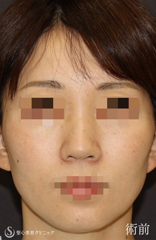 鼻尖縮小＋鼻尖形成（耳介軟骨移植）＋ストラット法（耳介軟骨移植）＋鼻柱形成（鼻柱下降術）_Before