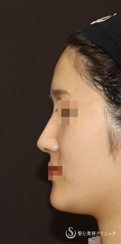 鼻中隔延長（肋軟骨）＋鼻尖形成＋鼻背軟骨移植＋鼻根部ダイス移植（肋軟骨）_After