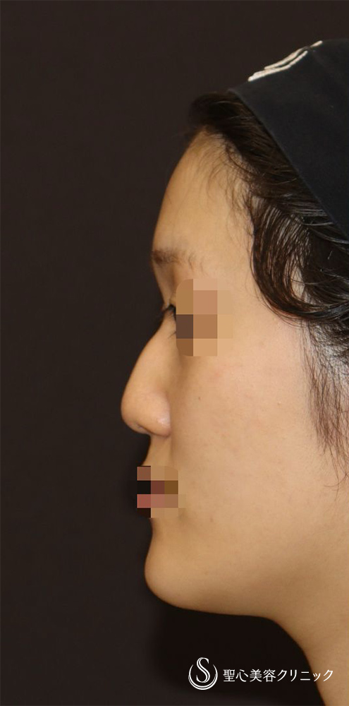 鼻中隔延長（肋軟骨）＋鼻尖形成＋鼻背軟骨移植＋鼻根部ダイス移植（肋軟骨）_Before