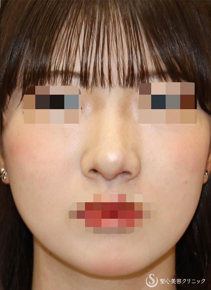 鼻翼縮小＋鼻翼挙上術＋他院修正_After