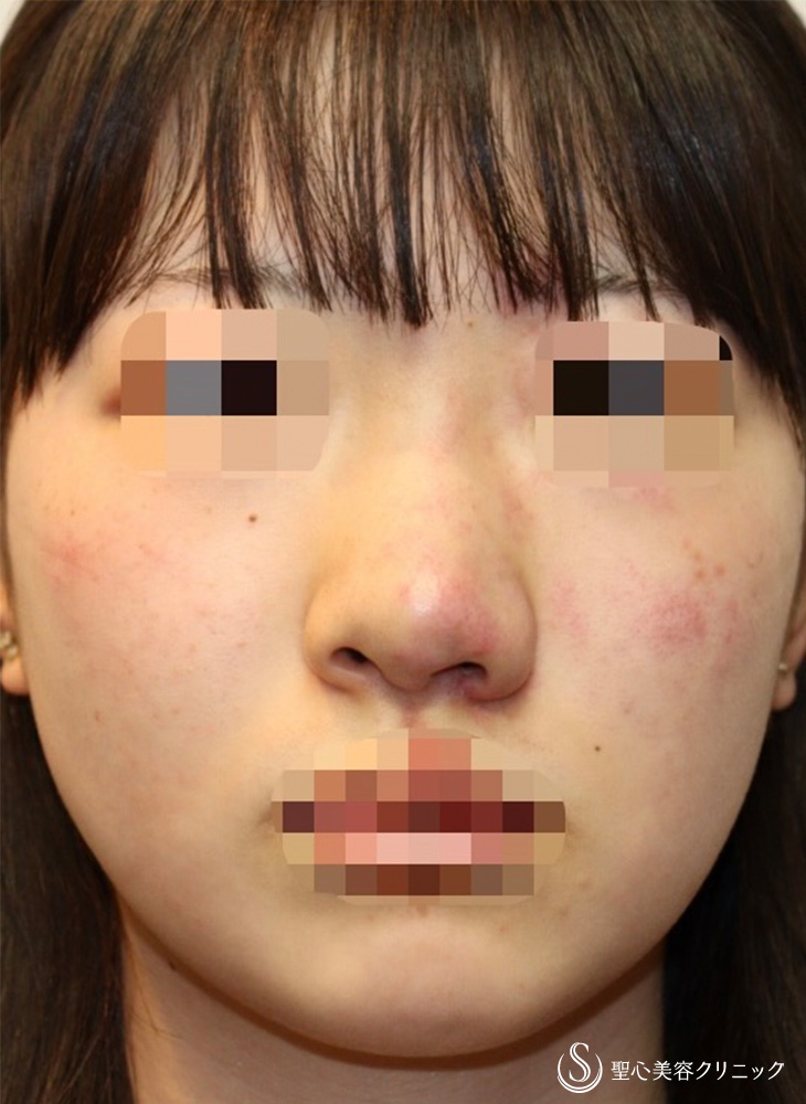 鼻翼縮小＋鼻翼挙上術＋他院修正_Before