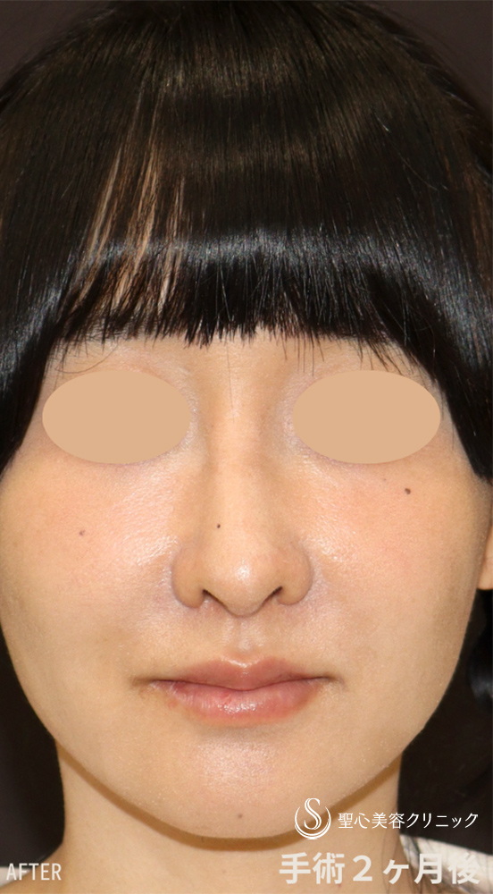 鼻尖縮小＋鼻尖形成（耳介軟骨移植）＋ストラット法（耳介軟骨）＋隆鼻プロテーゼ＋鼻孔縁下降術＋他院修正_After