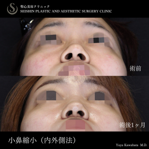 小鼻縮小（内側法＋外側法）_After