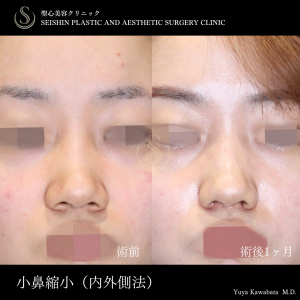 小鼻縮小（内側法＋外側法）_Before
