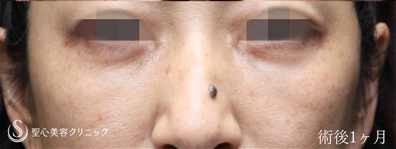 下眼瞼切開術/下眼瞼除皺術/ハムラ法_After