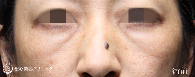 下眼瞼切開術/下眼瞼除皺術/ハムラ法_Before