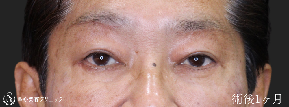 下眼瞼切開術/下眼瞼除皺術/ハムラ法＋眉下切開法（眉下リフト）_After
