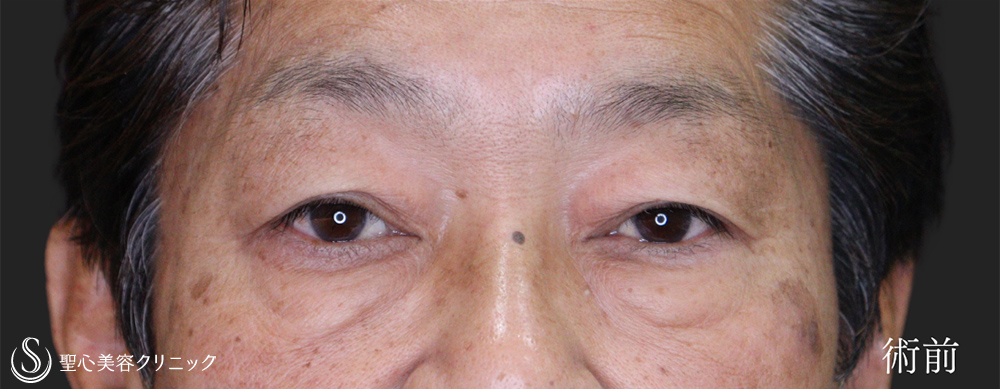 下眼瞼切開術/下眼瞼除皺術/ハムラ法＋眉下切開法（眉下リフト）_Before