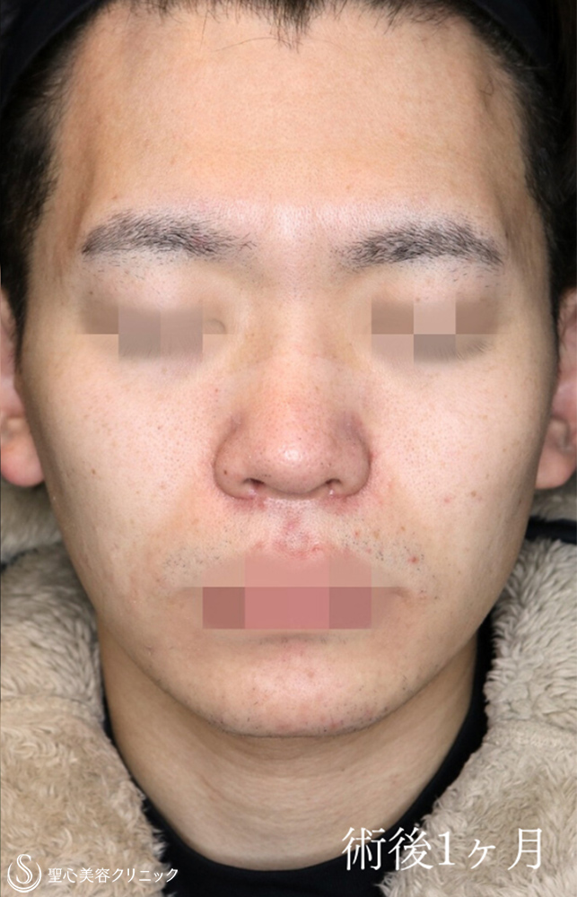 鼻尖縮小＋鼻尖形成（耳介軟骨移植）＋小鼻縮小_After