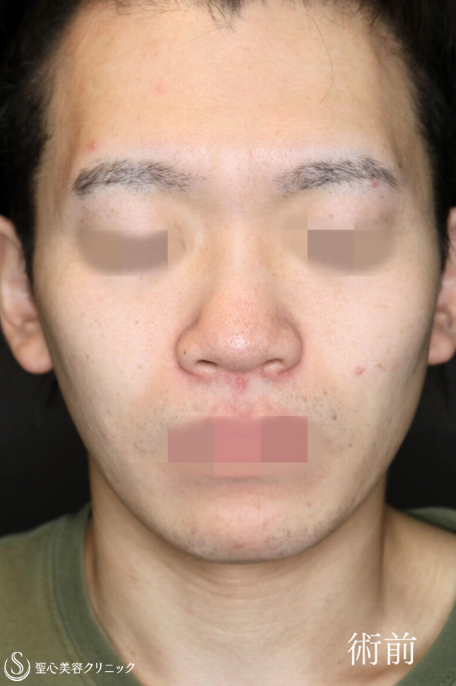 鼻尖縮小＋鼻尖形成（耳介軟骨移植）＋小鼻縮小_Before