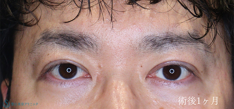 眼瞼下垂（切開法/腱膜縫縮法）_After