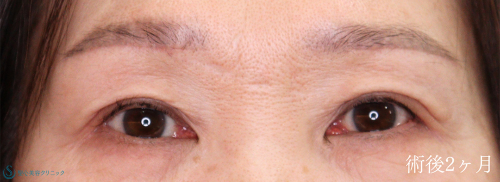 二重術（埋没法）：マイクロメソッド+α＋眉下切開法（眉下リフト）_After