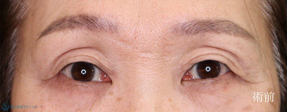 二重術（埋没法）：マイクロメソッド+α＋眉下切開法（眉下リフト）_Before