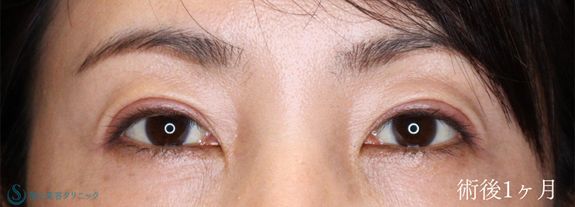 二重術（埋没法）：マイクロメソッド+α_After