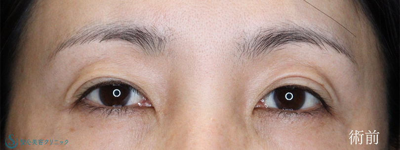 二重術（埋没法）：マイクロメソッド+α_Before