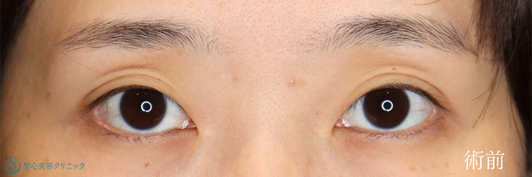 二重術（埋没法）：マイクロメソッド+α_Before