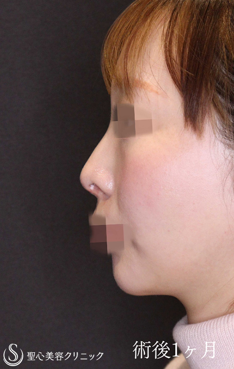 鼻中隔延長術＋鼻尖縮小＋鷲鼻修正（わし鼻修正、整鼻術・低鼻術）_After