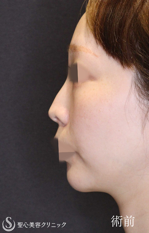 鼻中隔延長術＋鼻尖縮小＋鷲鼻修正（わし鼻修正、整鼻術・低鼻術）_Before