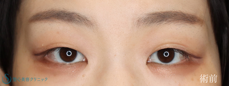 二重術（埋没法）：マイクロメソッド+α＋目頭切開/目上切開_Before