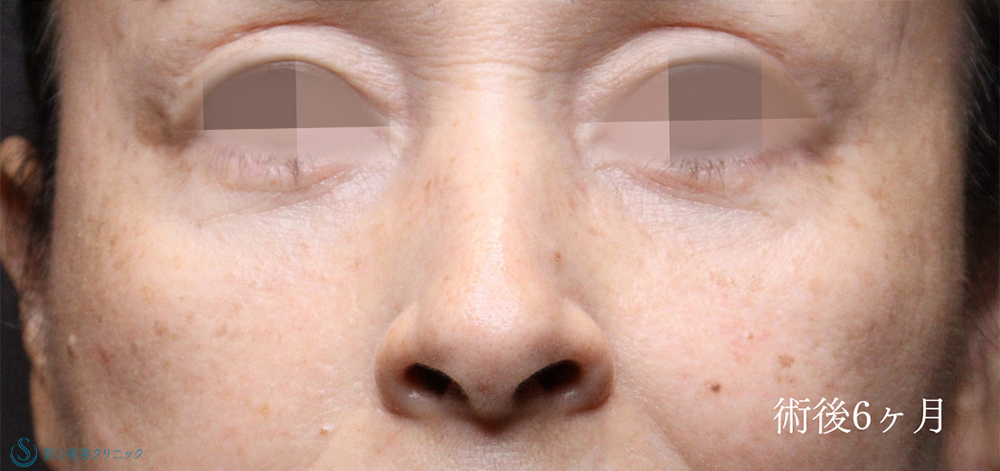 下眼瞼切開術/下眼瞼除皺術/ハムラ法_After