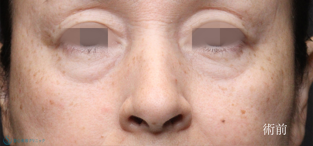 下眼瞼切開術/下眼瞼除皺術/ハムラ法_Before