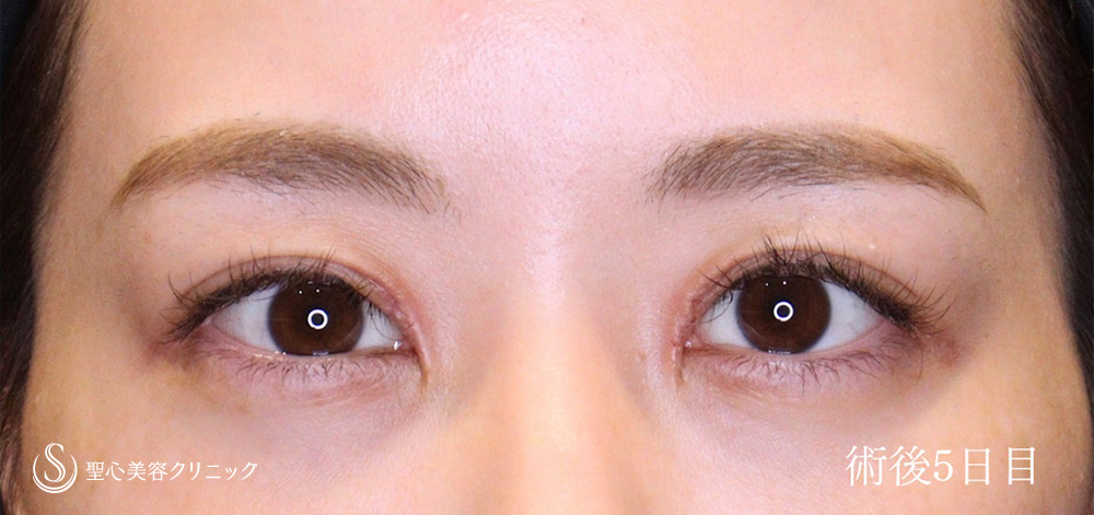 目頭切開/目上切開_After