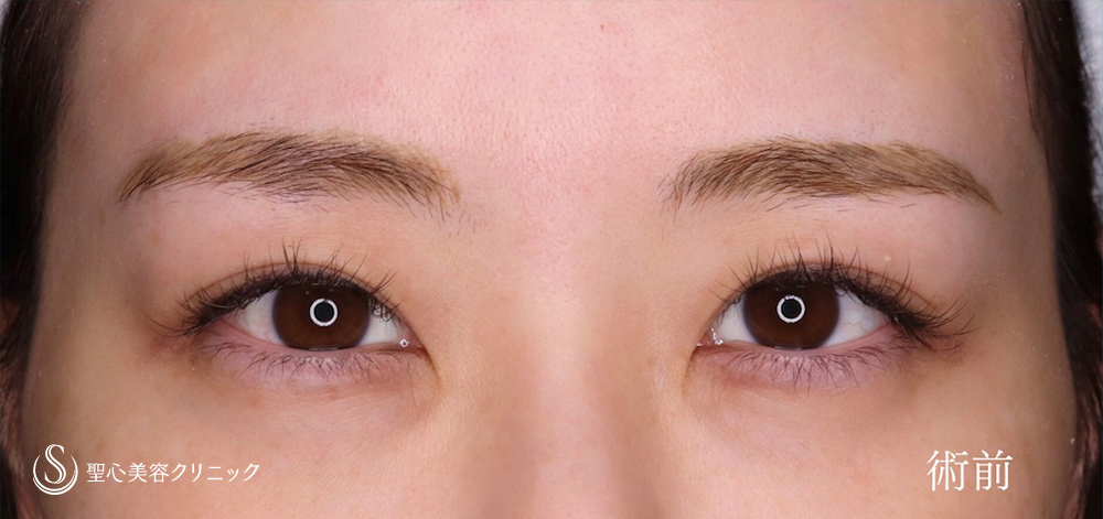 目頭切開/目上切開_Before