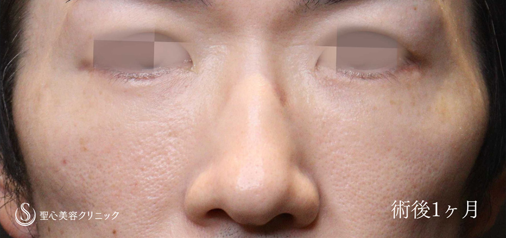 下眼瞼切開術/下眼瞼除皺術/ハムラ法_After