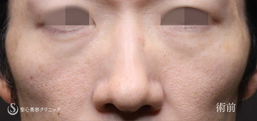 下眼瞼切開術/下眼瞼除皺術/ハムラ法_Before