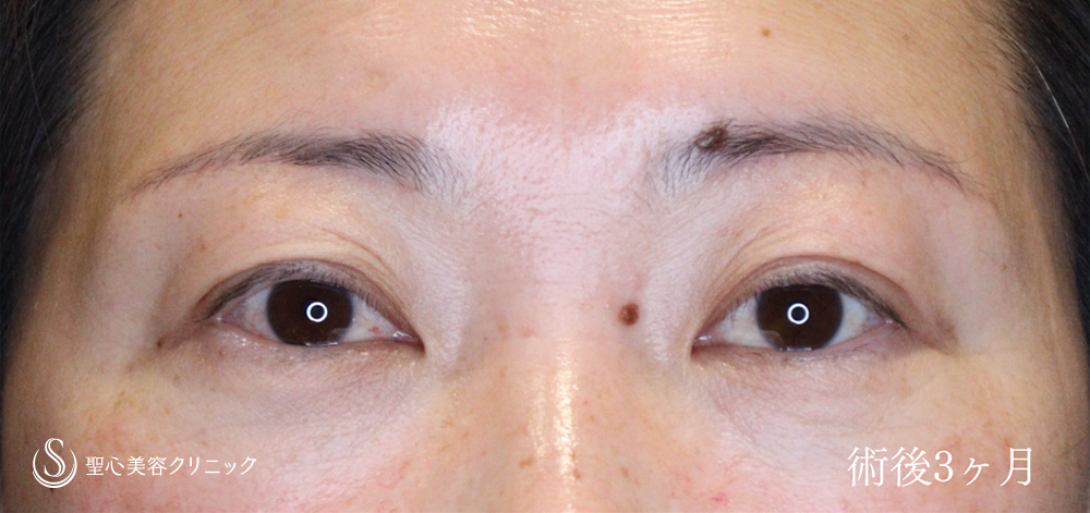 眉下切開法（眉下リフト）_After