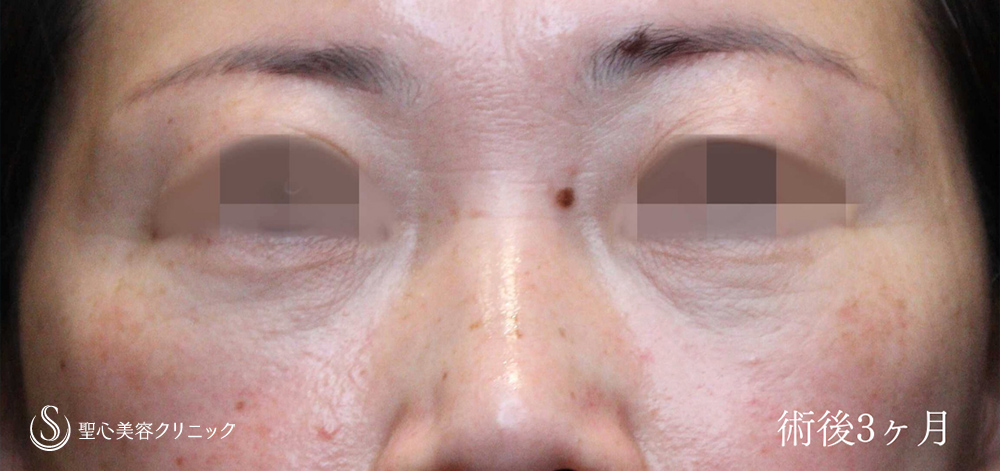プレミアムPRP皮膚再生療法（目の下のくま）_After