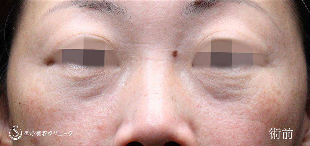 プレミアムPRP皮膚再生療法（目の下のくま）_Before